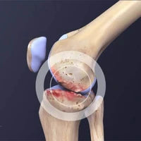 Inflamación Articular