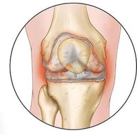 Osteoartritis